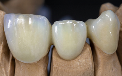 3 Unit Bridge Layering with Zirconia