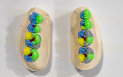 Anatomical Wax-up & Li-Pressing