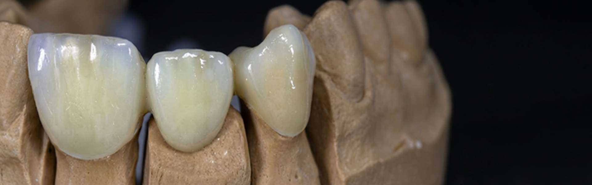 Zirconia Posterior Banner